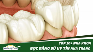 TOP 10+ Địa Chỉ Bọc Răng Sứ Nha Trang