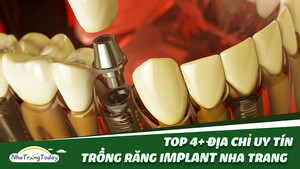 TOP 6+ Địa Chỉ Trồng Răng Implant Nha Trang